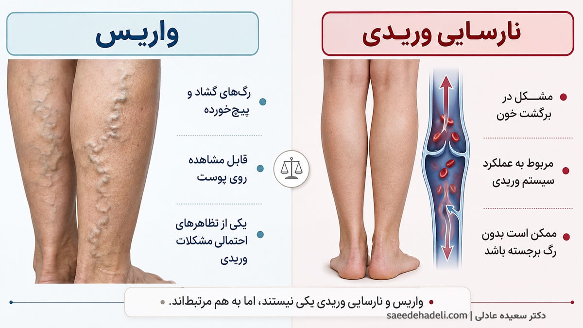 تفاوت نارسایی وریدی و واریس در رگ‌های پا