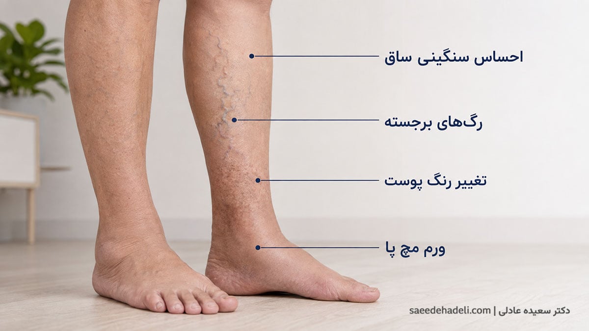 علائم نارسایی وریدی پا شامل ورم، سنگینی و تغییرات پوستی