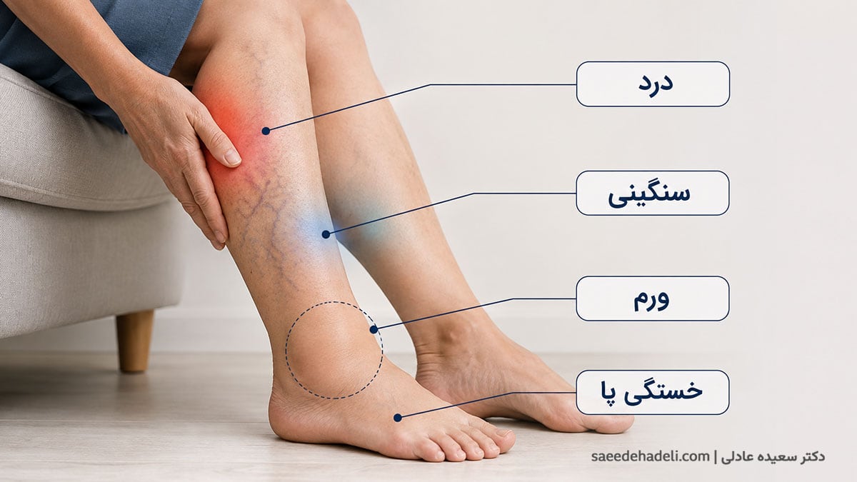 داروی واریس برای کاهش درد، سنگینی و ورم پا