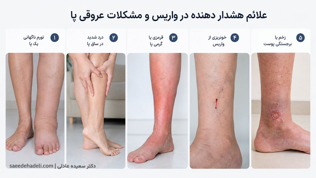 اینفوگرافیک علائم هشدار درد واریس شامل ورم یک پا، درد شدید ساق، قرمزی و خونریزی از رگ واریسی