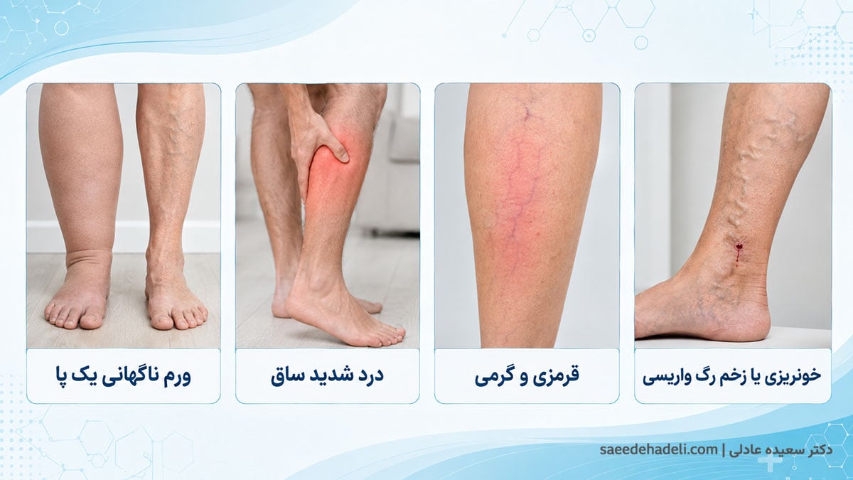 علائم هشدار واریس مانند ورم ناگهانی یک پا، درد شدید ساق و قرمزی رگ