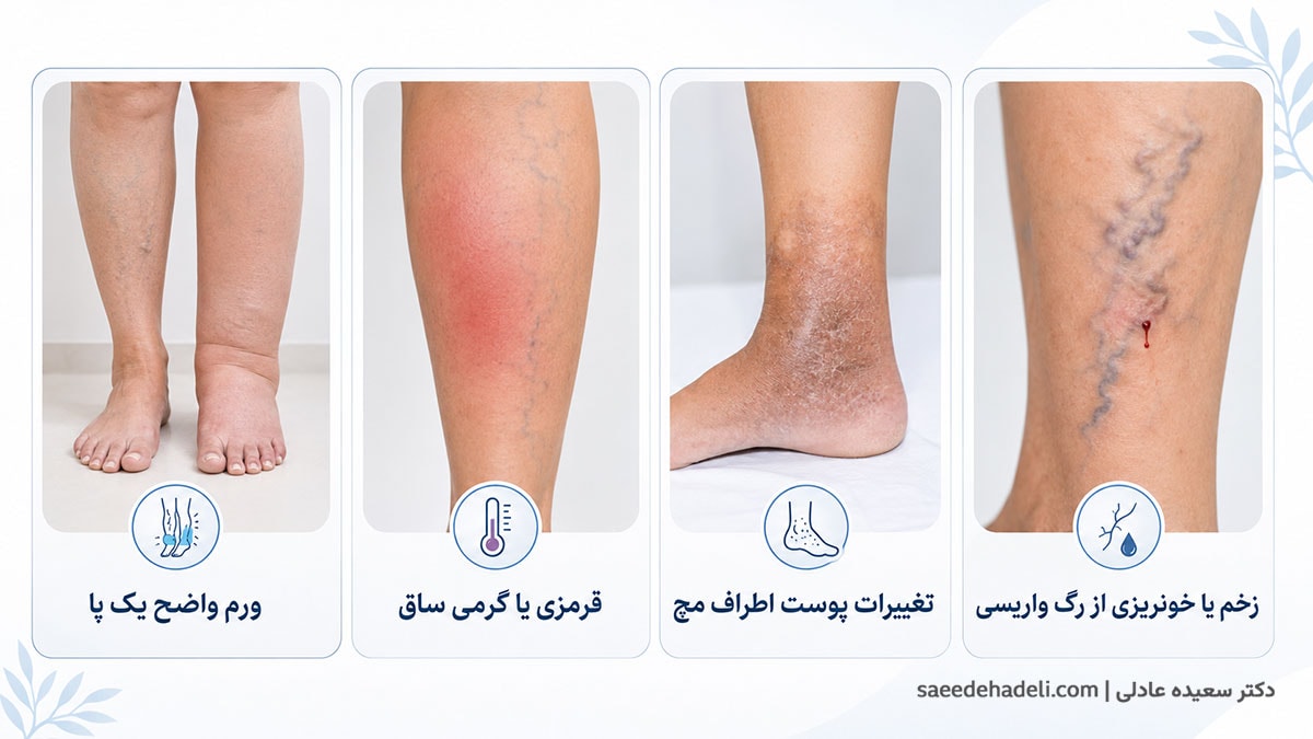 علائم مهم واریس شامل ورم یک پا، قرمزی، تغییر پوست و زخم
