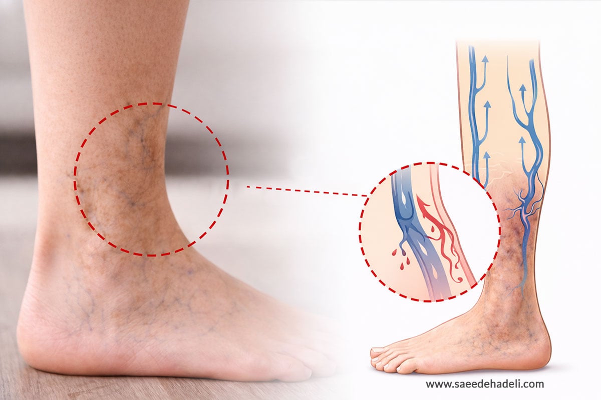 درمان تغییر رنگ پوست پا ناشی از واریس