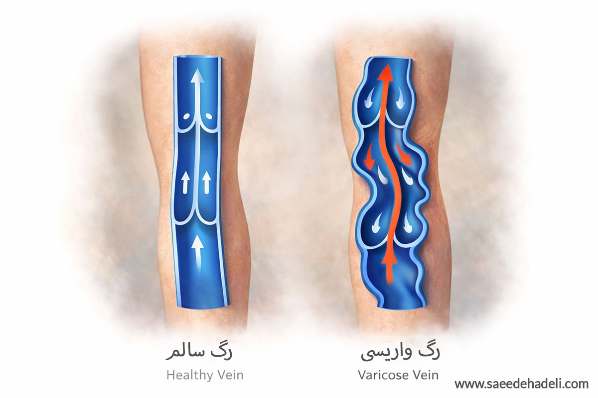 سونوگرافی داپلر واریس