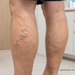 رگ‌های واریسی برجسته روی ساق پا برای بررسی خطر واریس