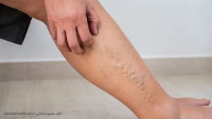 خارش پوست ساق پا در ناحیه دارای رگ‌های واریسی