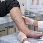درمان نارسایی وریدی پا و مشکلات گردش خون در رگ‌های پا