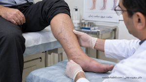 درمان نارسایی وریدی پا و مشکلات گردش خون در رگ‌های پا